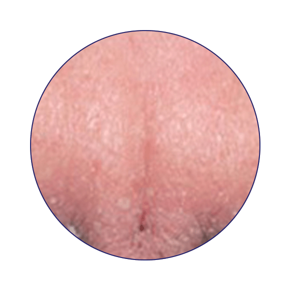 Seborrhoeic_Dermatitis_web