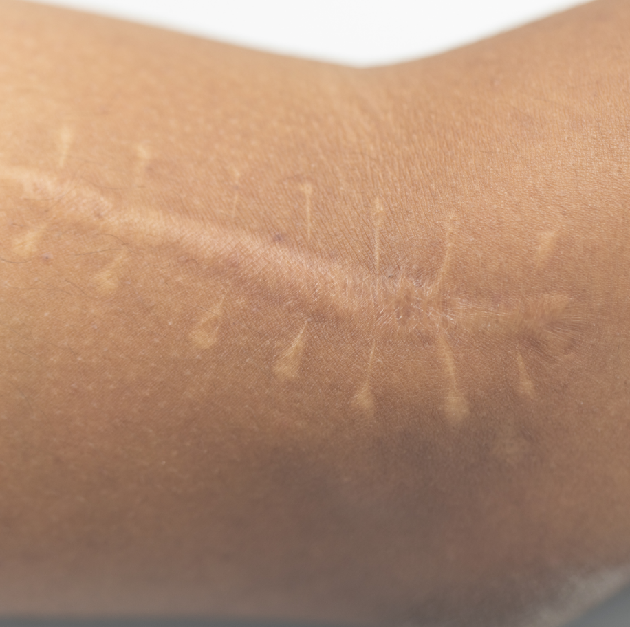 sc-hypertrophic-scars
