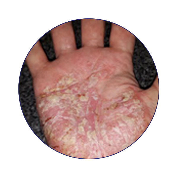 What Is Eczema Hydromol