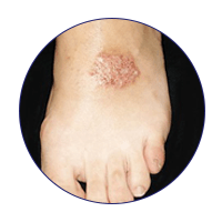 Discoid_Eczema_Web_WhatisEczema[66]