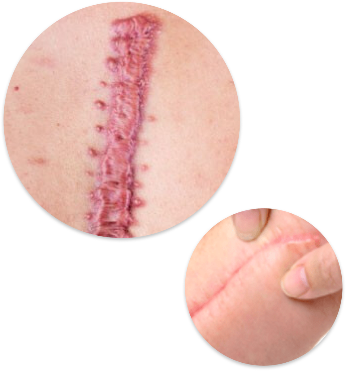 Hypertrophic scar