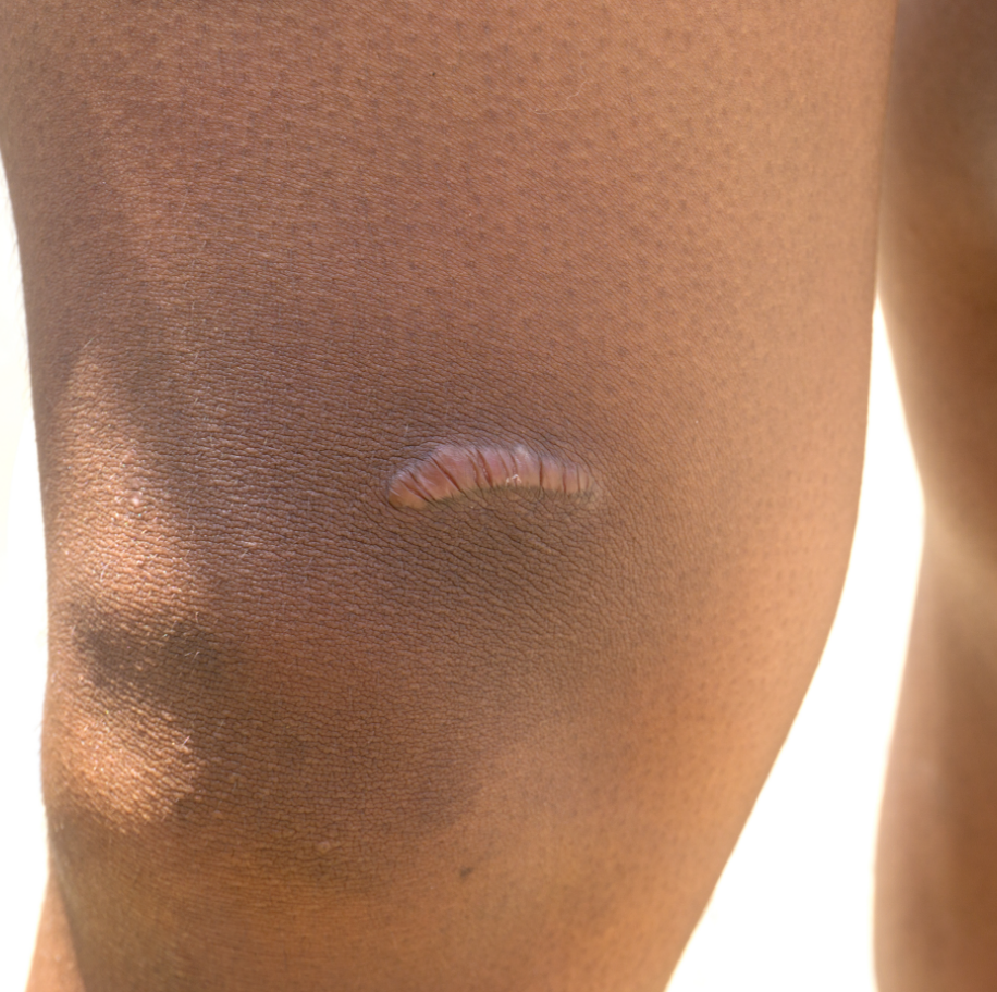 sc-keloid-scars