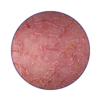 Asteotitic_Eczema_Web_WhatisEczema[2]